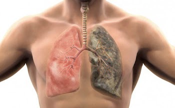 Bệnh phổi và nguyên nhân gây ra bệnh phổi