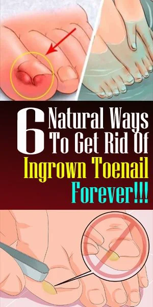 6 Natural Remedies For Ingrown Toenails