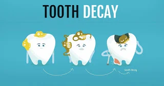 tooth-decay-in-toddlers