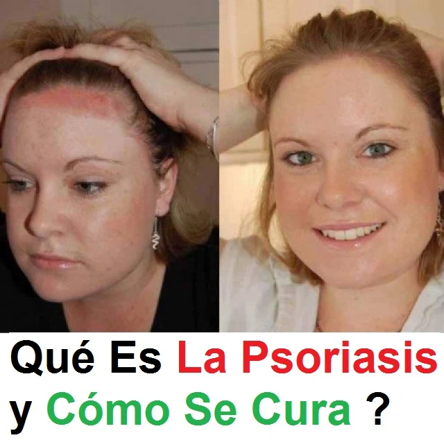 que-es-la-psoriasis-como-se-cura-tratamiento-natural