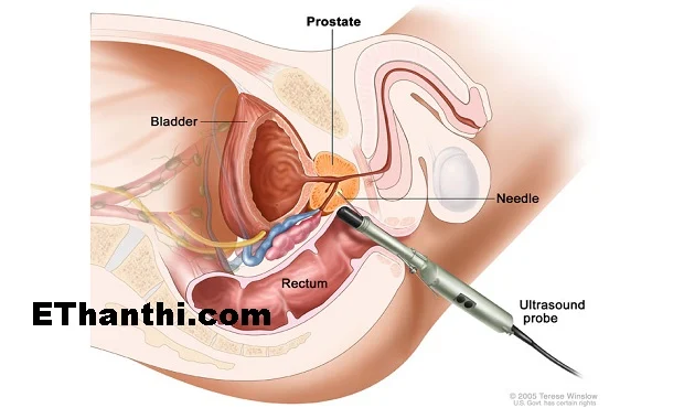 ப்ராஸ்டேட் புற்றுநோய்