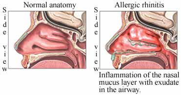 Mommy's Diary of Life: ALLERGIC RHINITIS – ALAHAN 