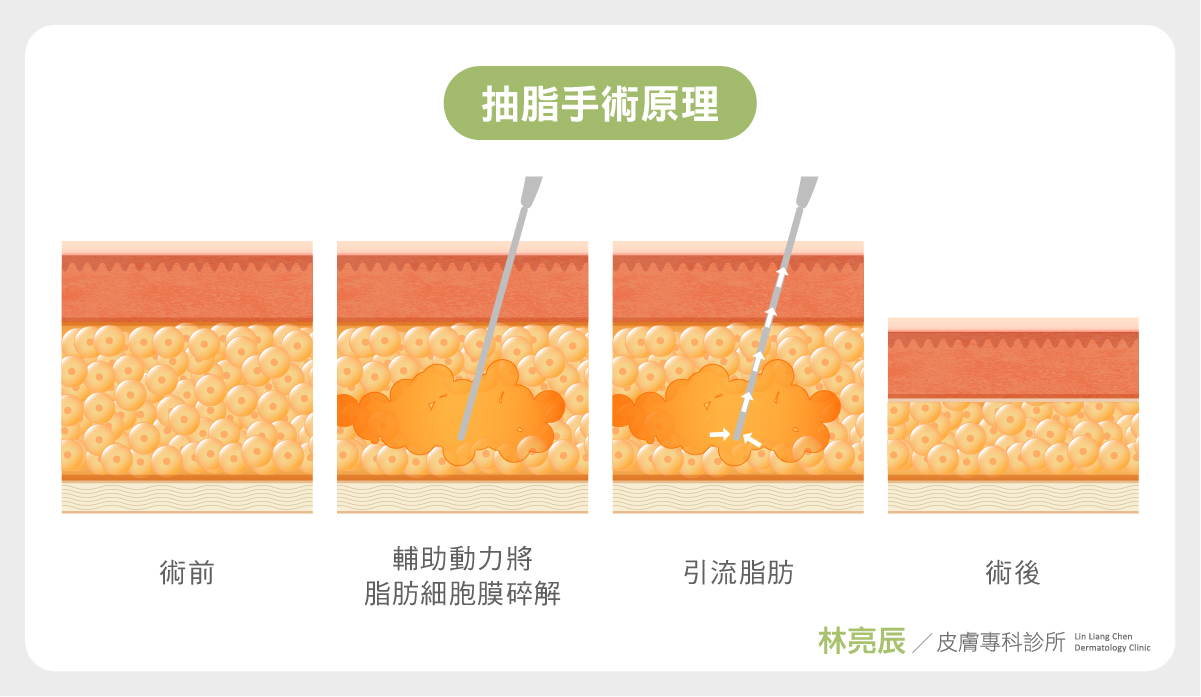 抽脂手術原理先將脂肪細胞碎解後以負壓抽出脂肪