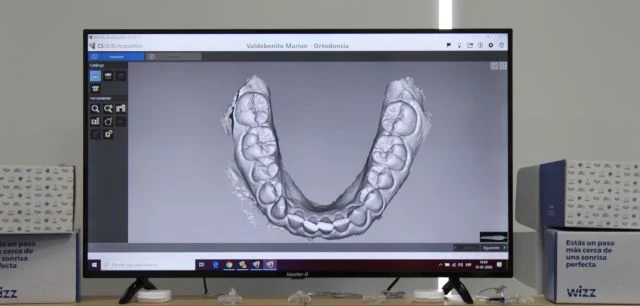 Alineación dental invisible