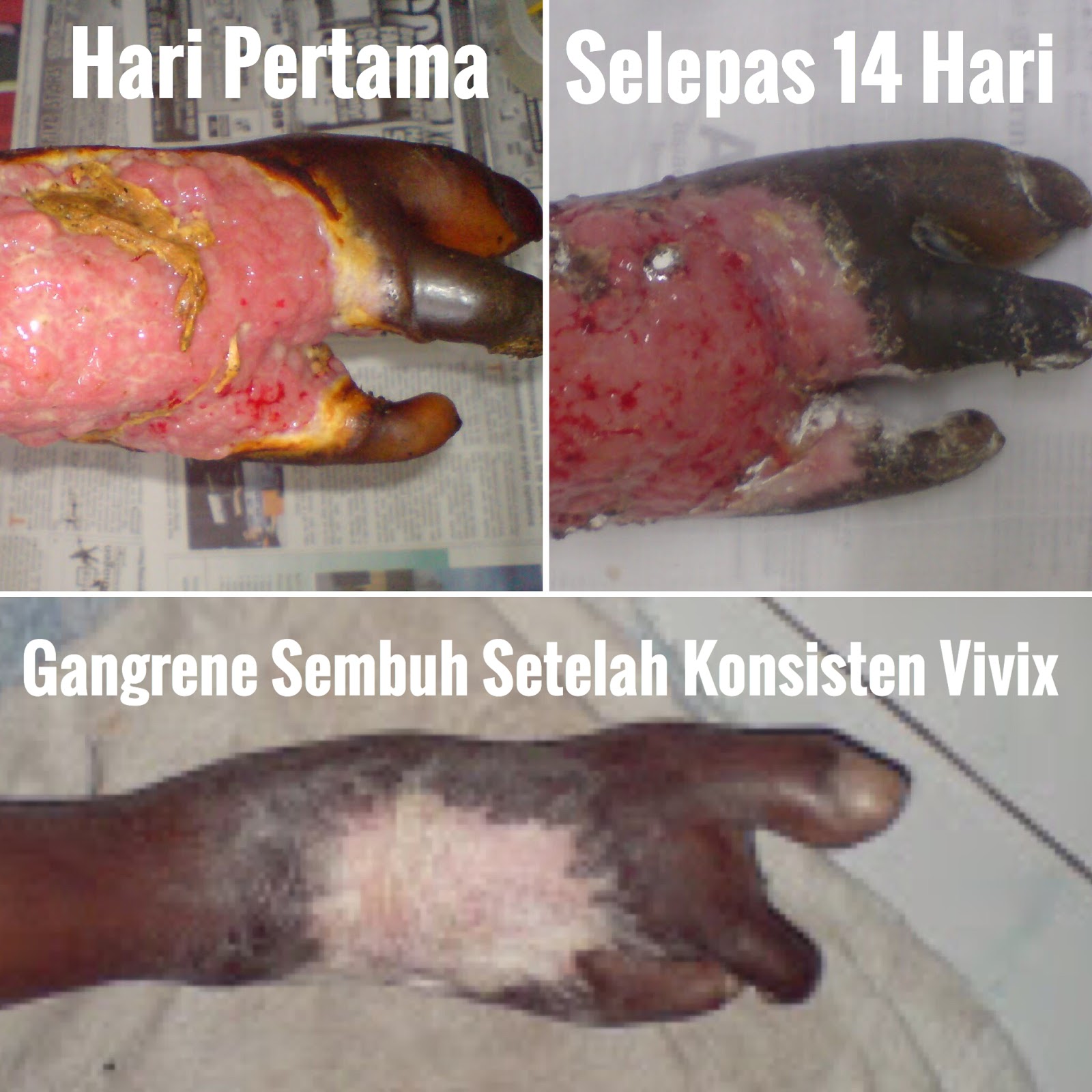 Vivix Ubat Untuk Gangrene Kencing Manis, Berkesan  Hadiah 