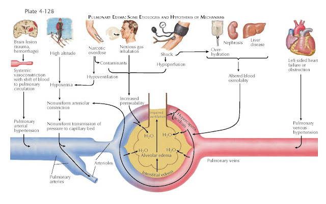 PULMONARY EDEMA: SOME ETIOLOGIES AND HYPOTHESES OF MECHANISMS