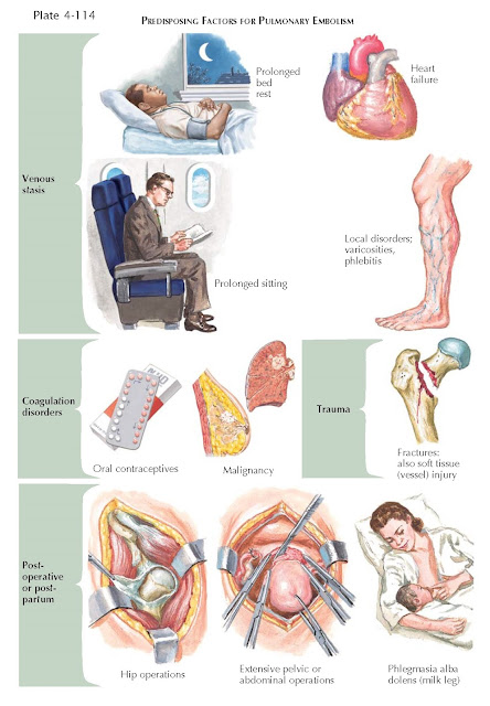 PREDISPOSING FACTORS FOR PULMONARY EMBOLISM