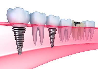 Cấy ghép răng implant có đau không ?