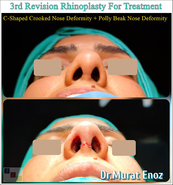 3rd Revision Rhinoplasty For Treatment of "C-Shaped Crooked Nose Deformity" + "Polly Beak Nose Deformity"