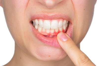 Hậu quả từ việc bọc răng sứ bị hở bạn nên lường trước-1