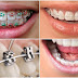 Các phương pháp niềng răng người lớn