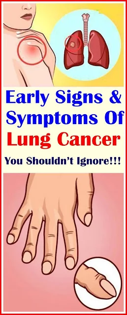 Early Signs and Symptoms Of Lung Cancer You