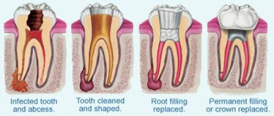 Rotary Endodontics Course, Endodontics Course India, Endodontic Courses in India, Endodontic Certificate Course