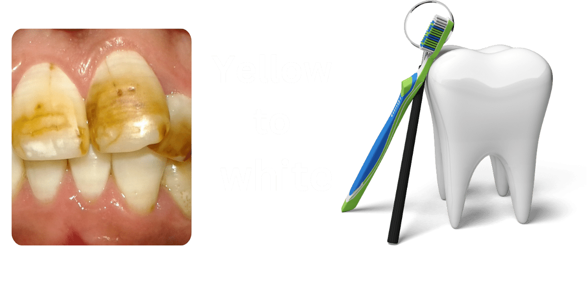 Best way to whiten teeth professionally | teeth whitening at home in 2 minutes