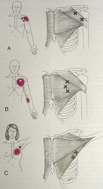 MIOTERAPIA