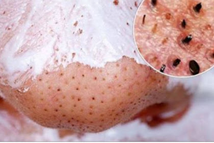 BLACKHEADS: Get Rid Of Blackheads Permanently With a Help Of This Simple Trick