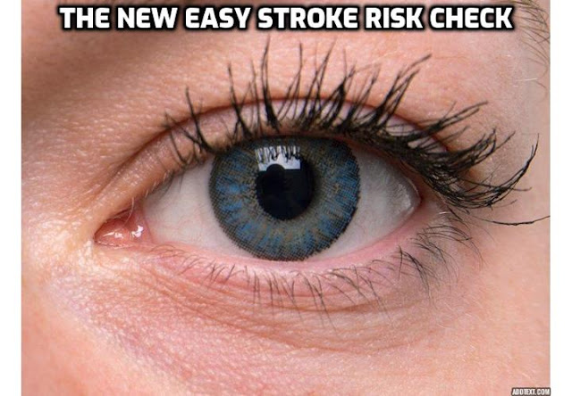 Clear Out Your 93% Cholesterol Clogged Arteries - The New Easy Stroke Risk Check. It just got easier to identify imminent stroke, according to a recent study from the Singapore Eye Research Institute. So easy in fact, that all you have to do is say “cheese”. The researchers behind the study have discovered an amazing new way to identify whether or not a person is headed for a stroke without any invasive tests, and it’s as simple as taking a photograph.