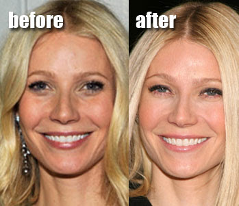 Gwyneth Paltrow before and after (image hosted by http://www.plasticcelebritysurgery.com)