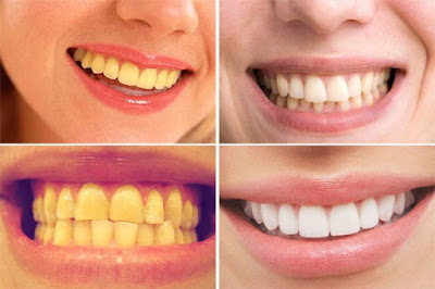 Cách làm trắng răng nhiễm tetracycline