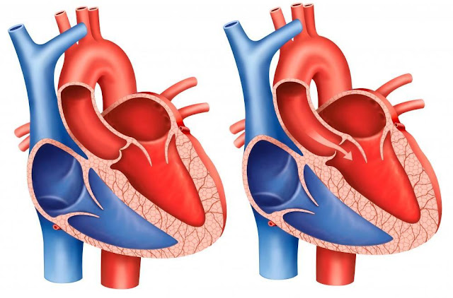 Aortic Stenosis Market