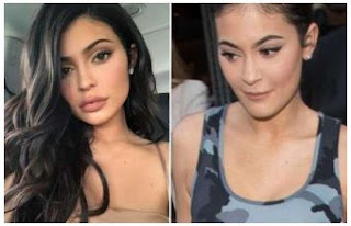 Kylie Jenner teen surgery