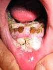 Mouth Disease