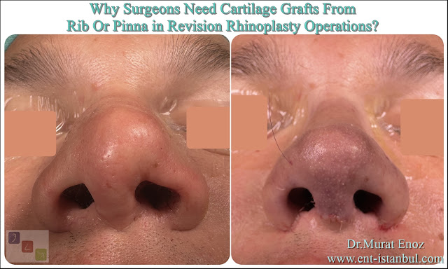 Revision nose job with irradiated rib cartilage,Revision Rhinoplasty Operation,irradiated homologous rib cartilage,Irradiated Cadaver Rib Cartilage,What is the "Autograft"?,What is the "Homograft"?,