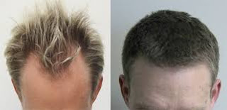 FUE hair transplant in Islamabad