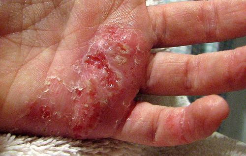 Penyakit Eczema : Punca dan Kaedah Rawatannya