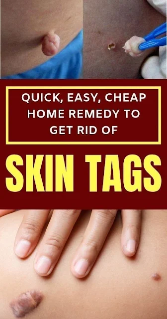 Quick, Easy, Cheap Home Remedy To Get Rid Of Skin Tags