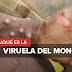 España confirma 7 casos de viruela del mono
