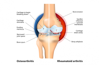 arthritis symptoms