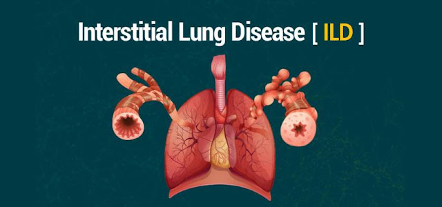 Interstitial Lung Disease Market