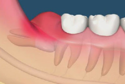 Răng khôn hàm dưới mọc lệch nên nhổ không?