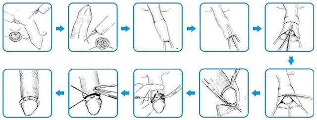 Hình ảnh cắt bao quy đầu thực tế nhất