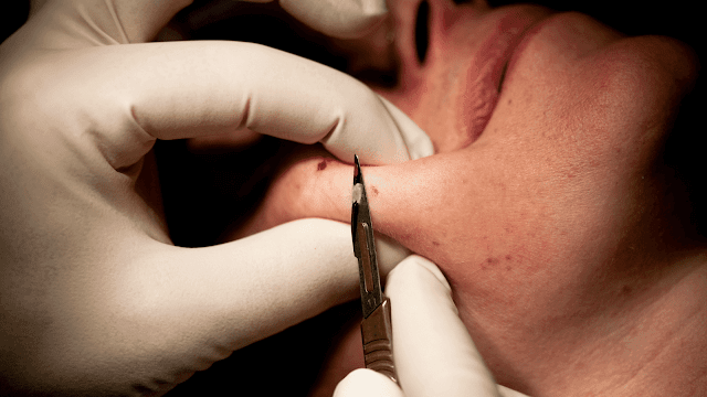 mole-removal-procedures-barbies-beauty-bits