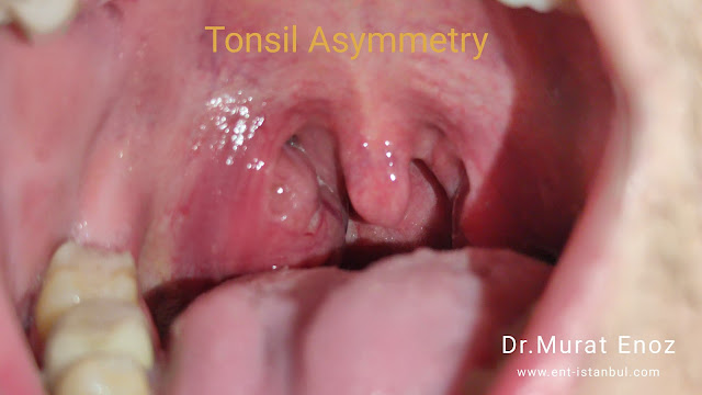 Tonsil Asymmetry
