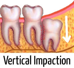 infected wisdom tooth pictures (vertical impaction)