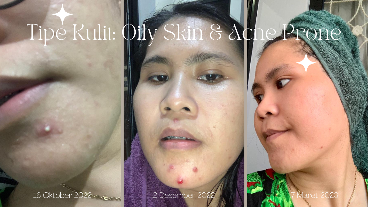 Tipe Kulit: Oily & Acne prone