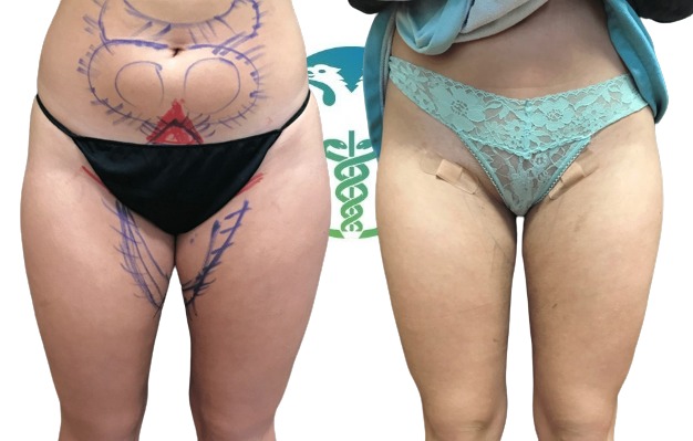 Una donna di 45 anni dopo la liposuzione delle cosce a Tirana dei medici italiani Davide Costantino e Giulio Gherardini
