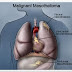 About Mesothelioma Attorneys and Lawyers