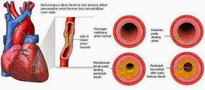 gambar Pembuluh Darah Jantung yang Tersumbat