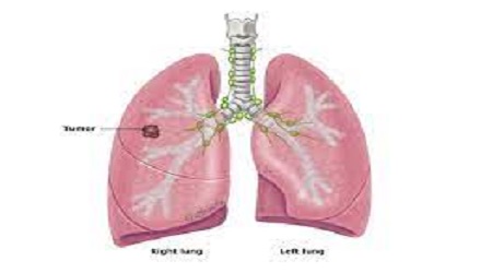 stage 1 lung cancer symptoms