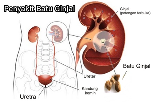 Pengobatan Herbal Batu Ginjal Terbaik