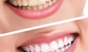 http://bristoldental.ca/dental-services/cosmetic-dentistry-mississauga/teeth-whitening/