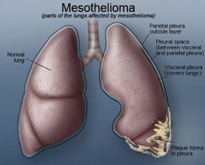 Mesothelioma Cancer, Understanding and Recognizing the Symptoms of Mesothelioma