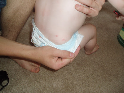 chicken pox. available for chicken pox,