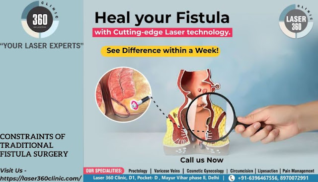 Fistula Treatment in Delhi