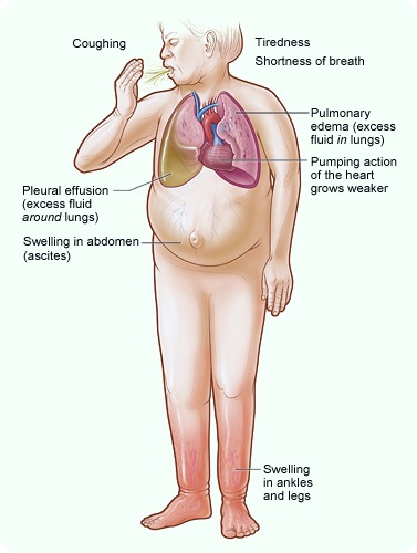 Gagal Jantung (Heart Failure-(HF))