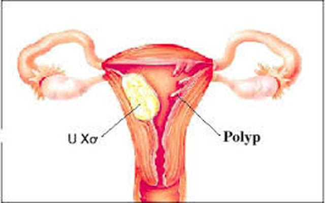 Polyp tử cung - Khối u tử cung - ảnh 01